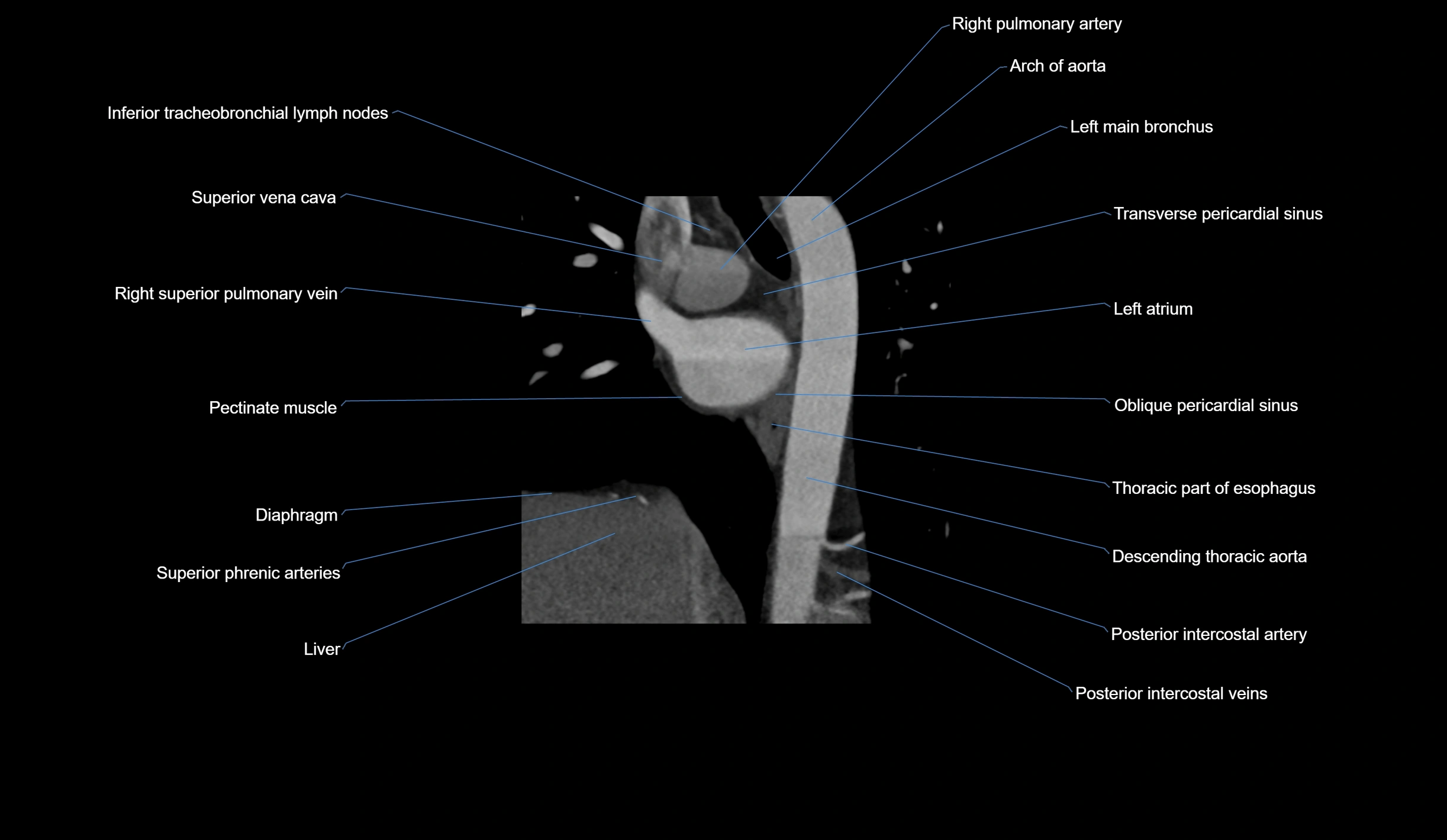 CT heart (coronary angiogram) short axis view  cross sectional anatomy labelled radiology image-00008.webp